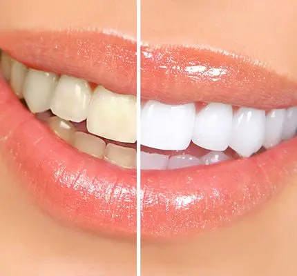 ​سفید کردن دندان​