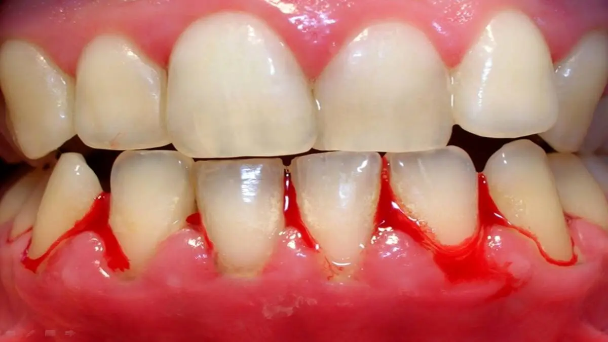 چگونه سریع خون ریزی دندان و لثه را متوقف کنیم؟