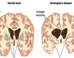 بیماری هانتینگتون چیست و چه نشانه‌ها و علائمی دارد؟