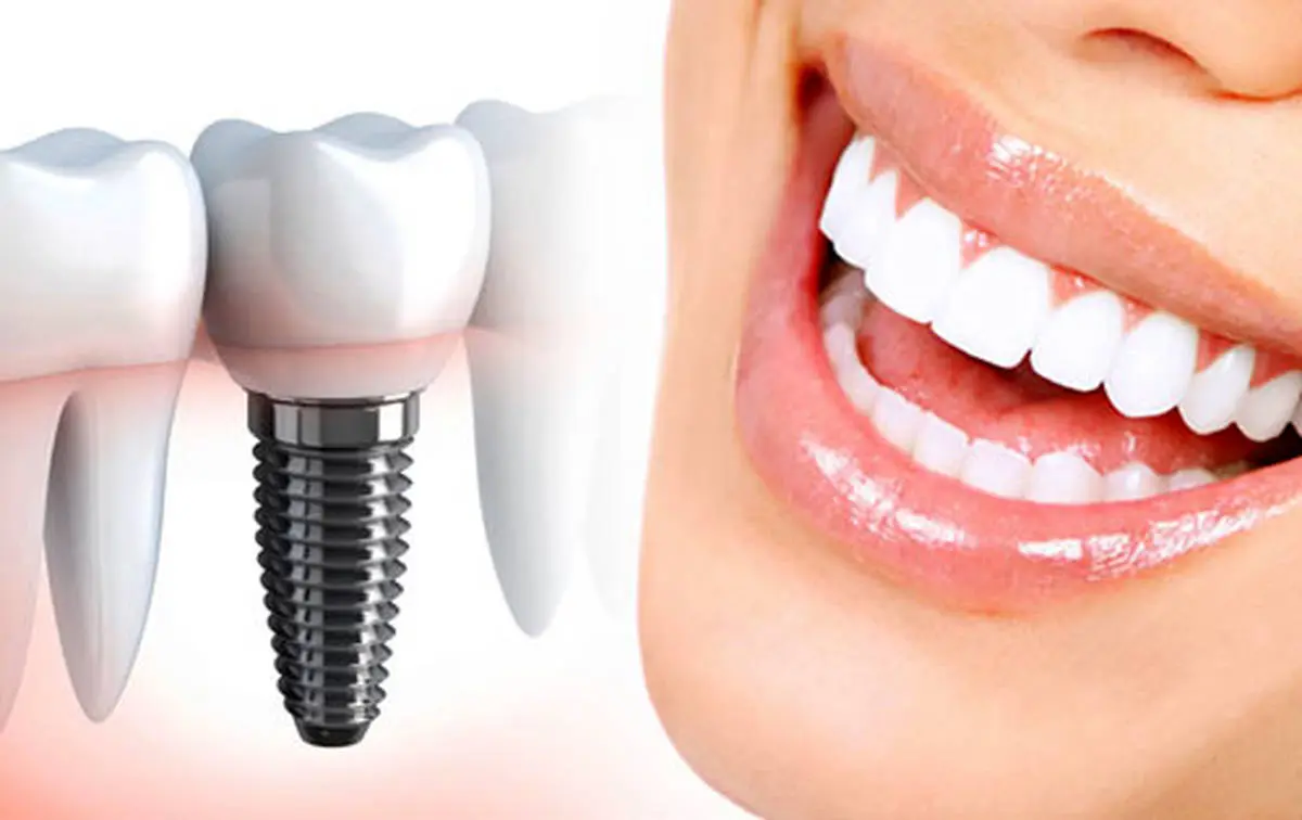 تفاوت ایمپلنت دندان با تاج دندان