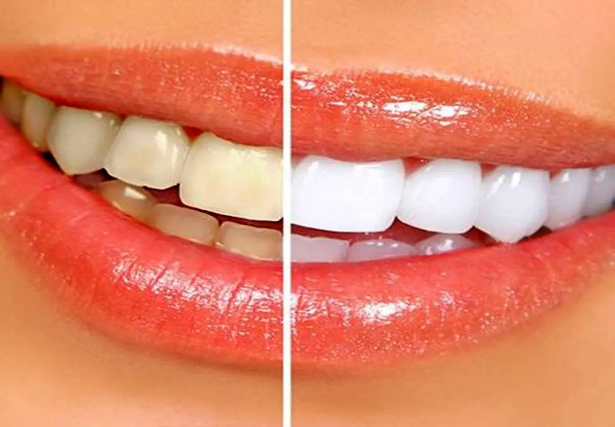 با بلیچینگ دندان، لبخند خود را متفاوت کنید
