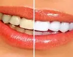 با بلیچینگ دندان، لبخند خود را متفاوت کنید
