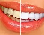 شماهم دنبال راهی برای سفید کردن دندانتان می باشید ؟ | دو راه حل تضمینی برای سفید کردن دندان در خانه