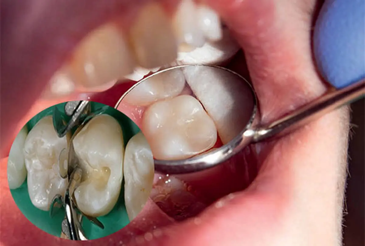 برای خرید مواد ترمیمی دندان‌پزشکی به چه نکاتی توجه کنیم؟
