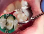 برای خرید مواد ترمیمی دندان‌پزشکی به چه نکاتی توجه کنیم؟
