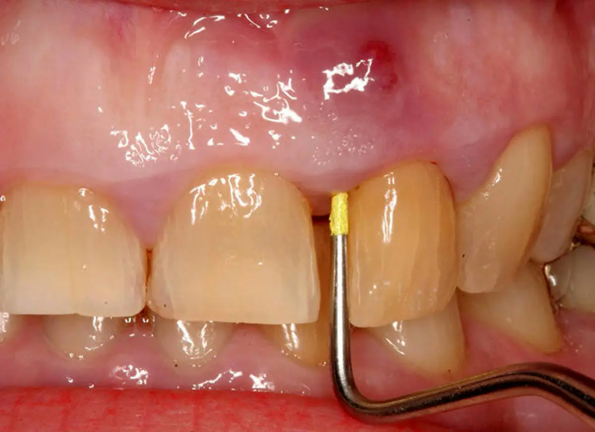 عفونت های دندانهایتان را با چه روش خانگی درمان کنید