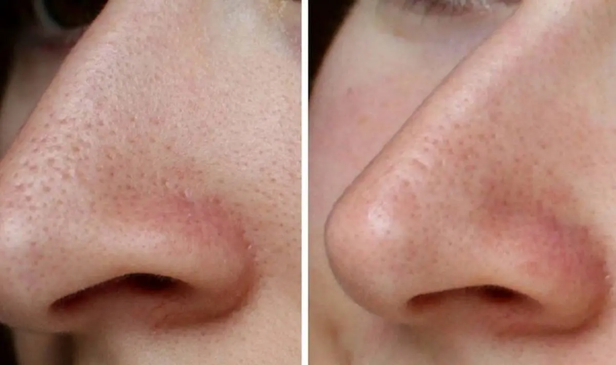 راهکارهای مفید برای کوچک کردن منافذ باز پوست صورت