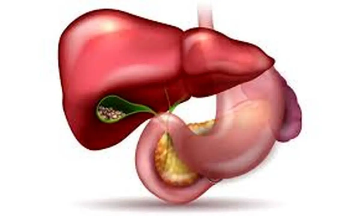  علائم پر شدن کیسه صفرا و راه‌های درمان آن: آنچه باید بدانید