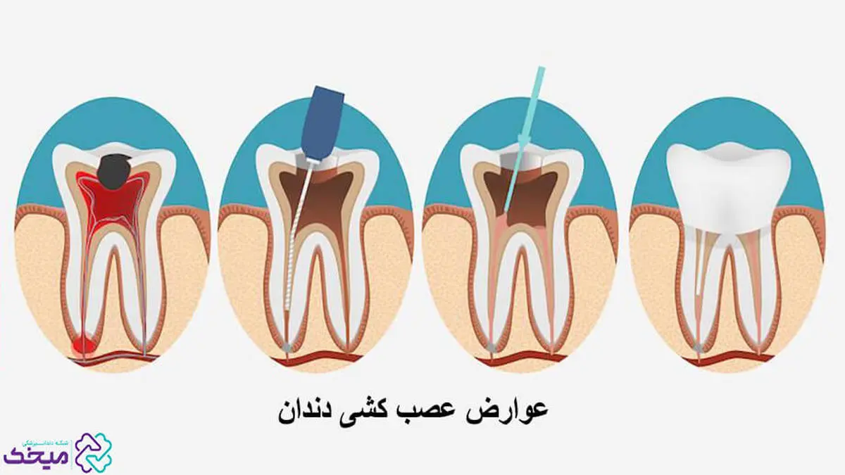 آیا عصب کشی دندان عوارض هم دارد؟