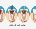 آیا عصب کشی دندان عوارض هم دارد؟