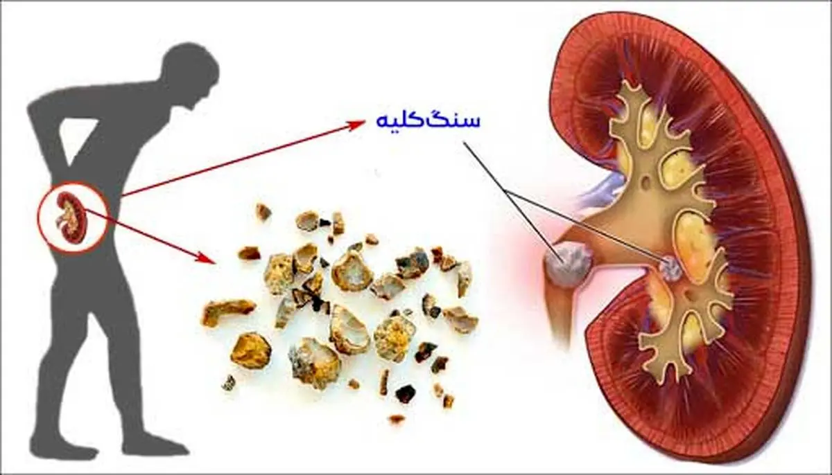  چگونه متوجه شویم که سنگ کلیه داریم؟ علائم، تشخیص و درمان

