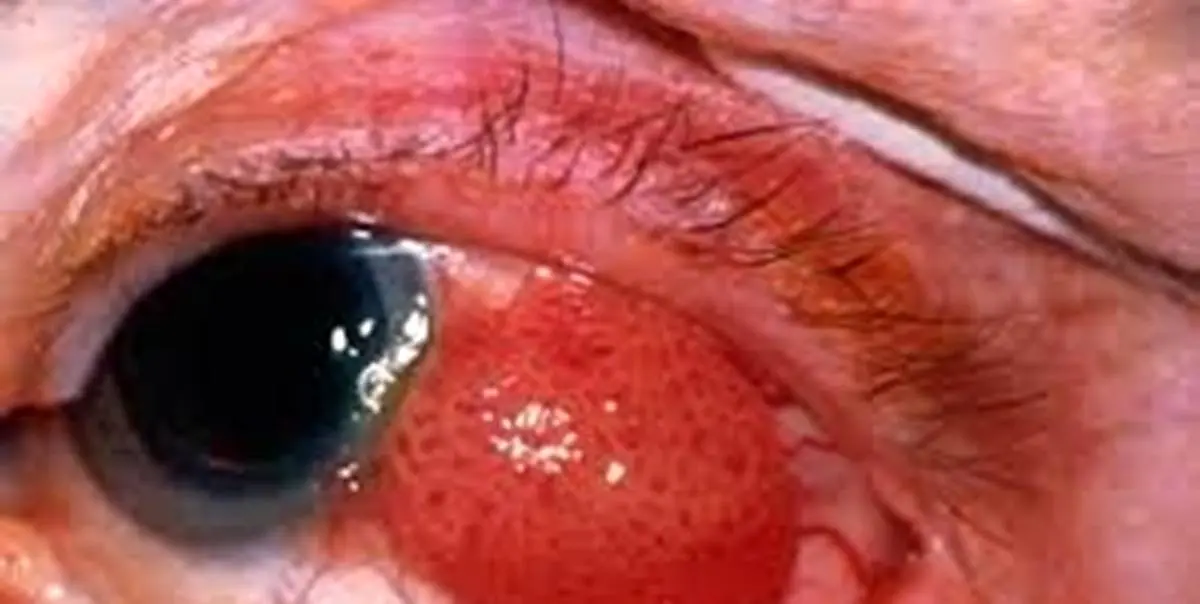 کاربرد سلول‌های بنیادی در درمان بیماری‌های چشمی