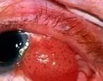 کاربرد سلول‌های بنیادی در درمان بیماری‌های چشمی