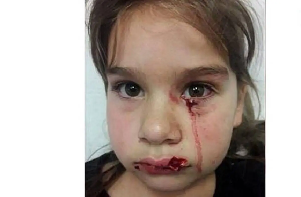 جزئیات حمله سگ وحشی به دختر ۵ ساله + عکس