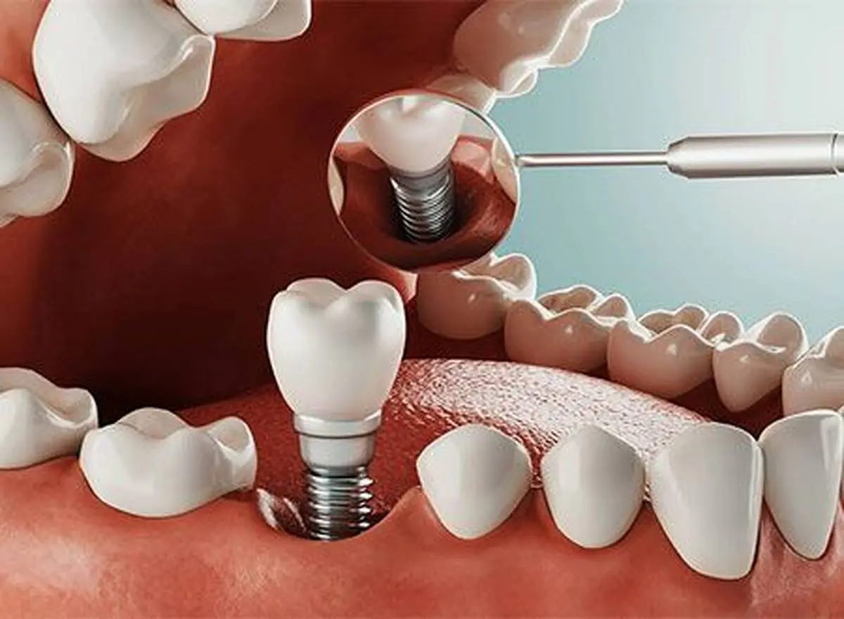 معرفی بهترین دندانپزشکان ایمپلنت دندان دیجیتال
