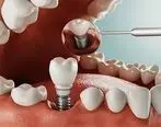 معرفی بهترین دندانپزشکان ایمپلنت دندان دیجیتال
