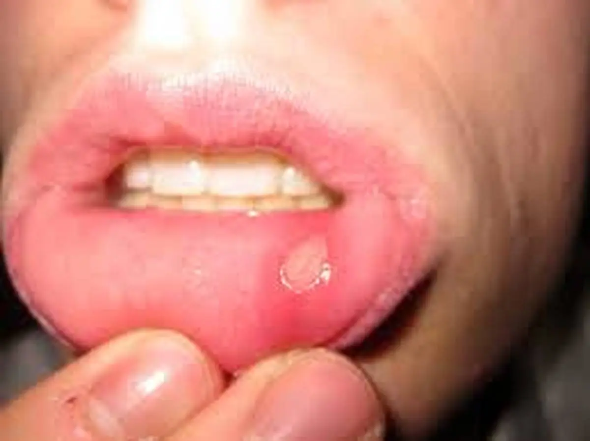 درمان فوری آفت دهان بدون دارو + فرمول ۷ نسخه طبیعی

