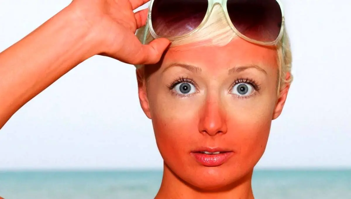 ۱۱ روش خانگی و فوق العاده برای درمان آفتاب سوختگی