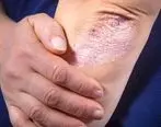 آشنایی با داء الصدف شایع ترین بیماری پوستی