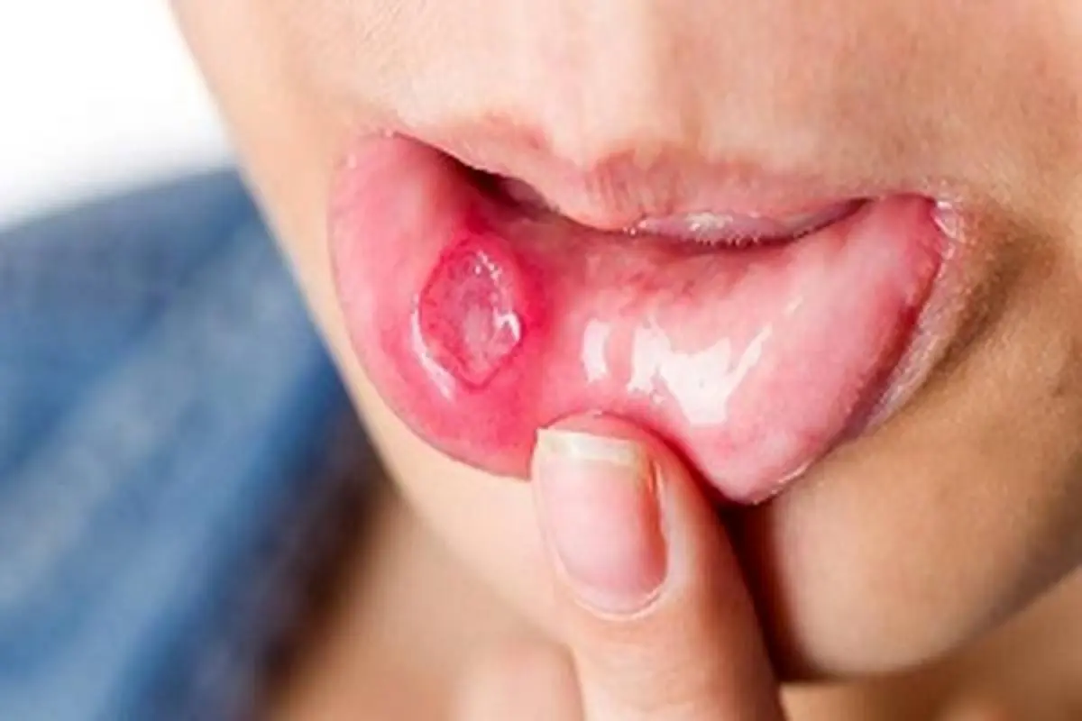 آفت دهان ، علل و روش های درمان