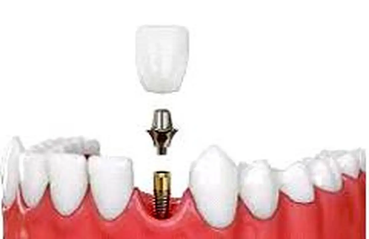 نکات کلیدی در ایمپلمت دندان را بدانید