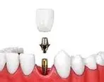 نکات کلیدی در ایمپلمت دندان را بدانید