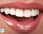 نظرات مردم درباره کامپوزیت دندان

