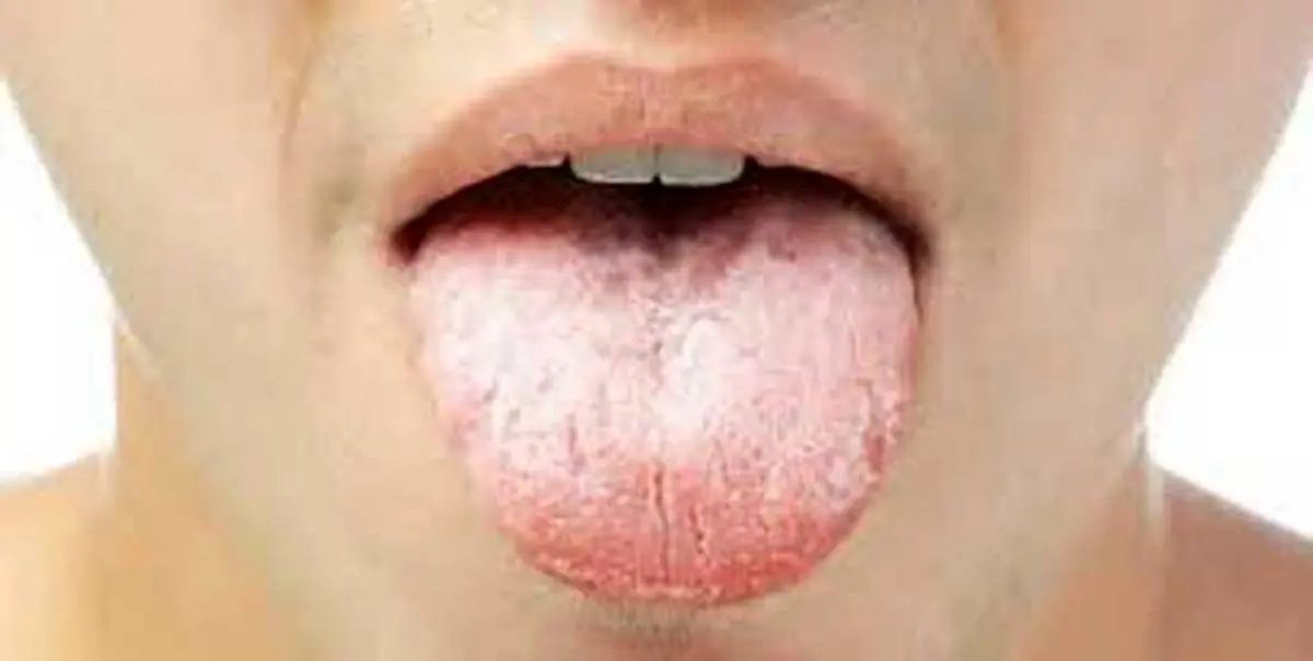 پوشش سفید و چسبنده زبان چیست؟