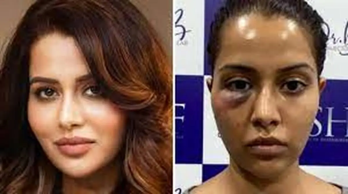 خانم بازیگر پس از عمل، صورتش منفجر شد! + عکس