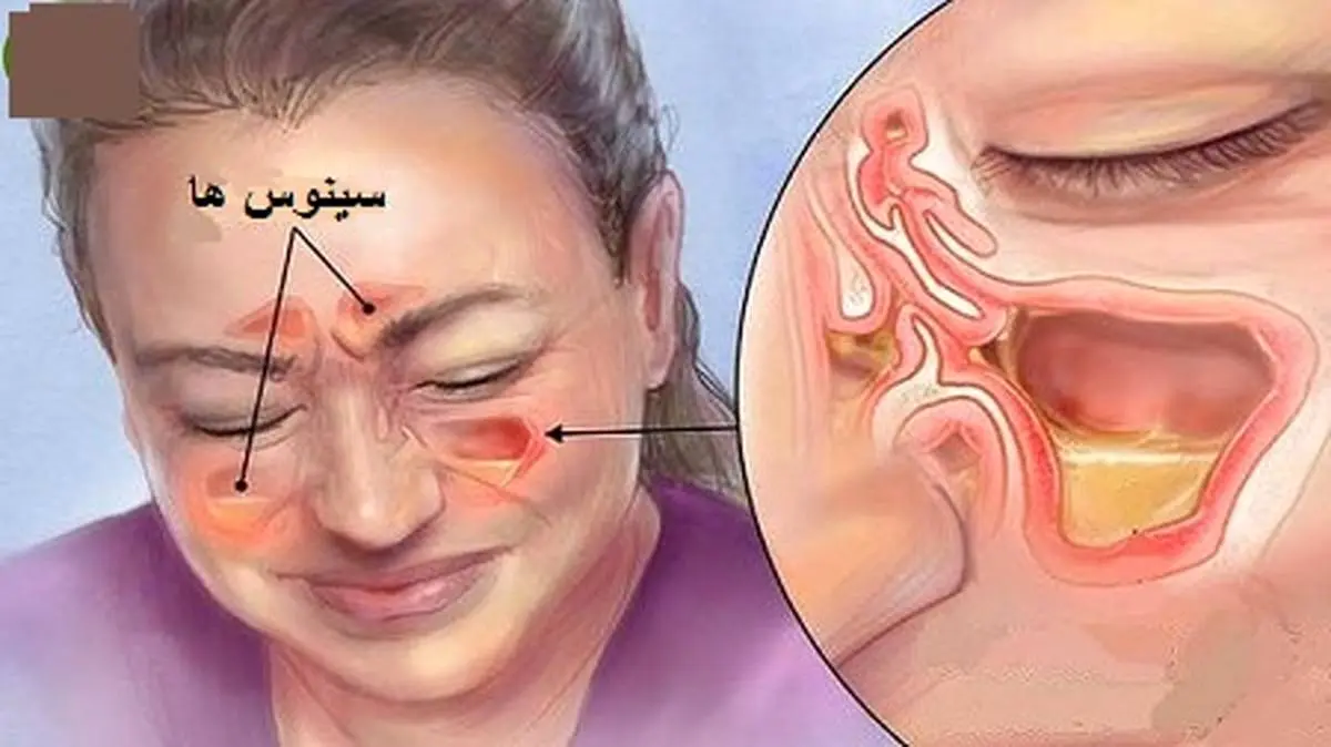 سینوزیت چیست؟ + روش درمان سریع سرما خوردگی

