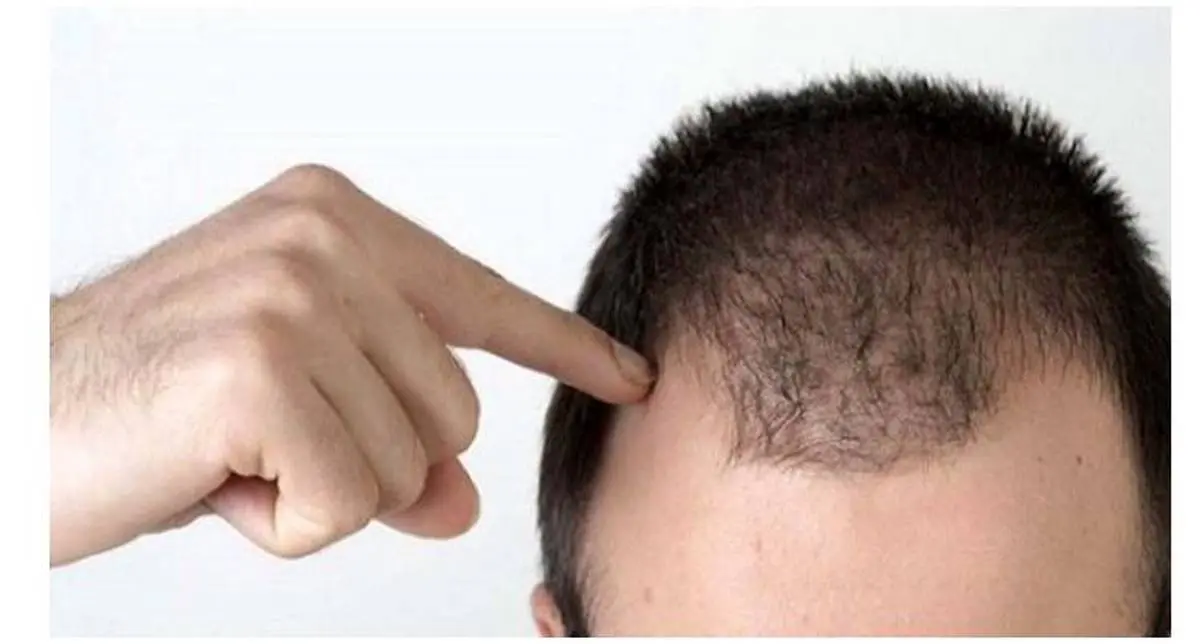 ریزش مو از تشخیص تا درمان