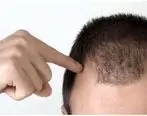 ریزش مو از تشخیص تا درمان