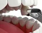  روش جلو گیری از پوسیدیگی دندان 