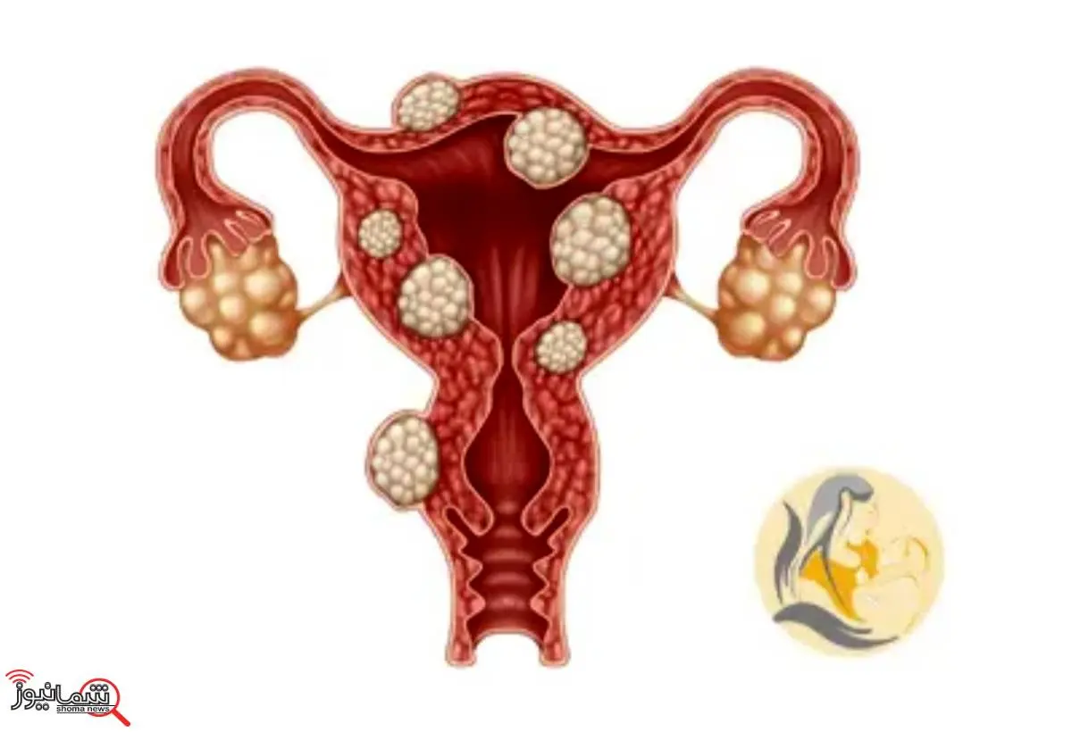 با روشی ساده در منزل کیست رحم را درمان کنید + فیلم