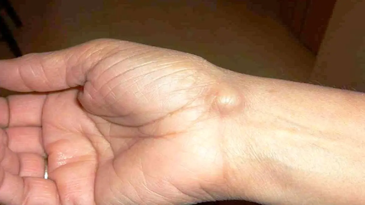 علل بروز کیست مچ دست چیست؟ + ترفند‌هایی سنتی برای درمان آن 