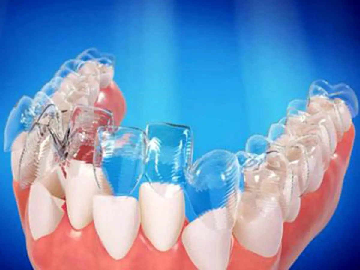 ارتودنسی شفاف جایگزین سیم کشی دندان ها