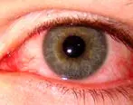 محققان: عارضه چشم صورتی نشانه ویروس کروناست