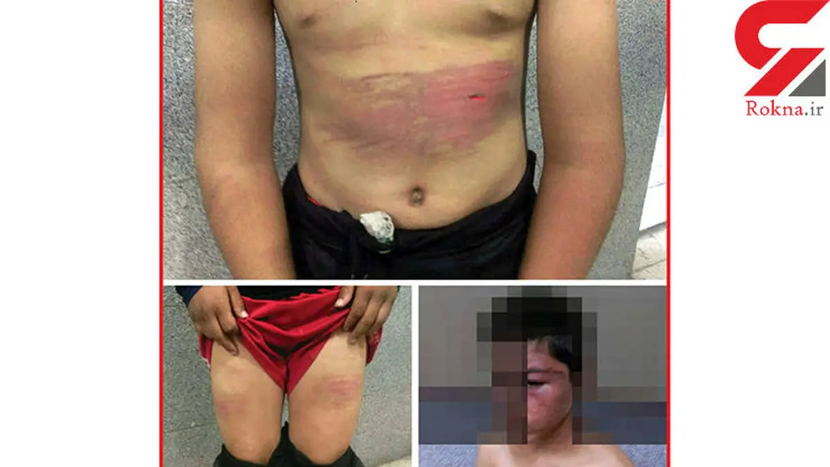 ضرب و شتم شدید پسر 12 ساله توسط پدر مشهدی + تصاویر دردناک 