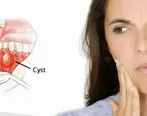 کیست دندان چیست؟ + علایم، پیشگیری و درمان 