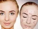 لک های صورتتان را با این ماسک جادویی درمان کنید