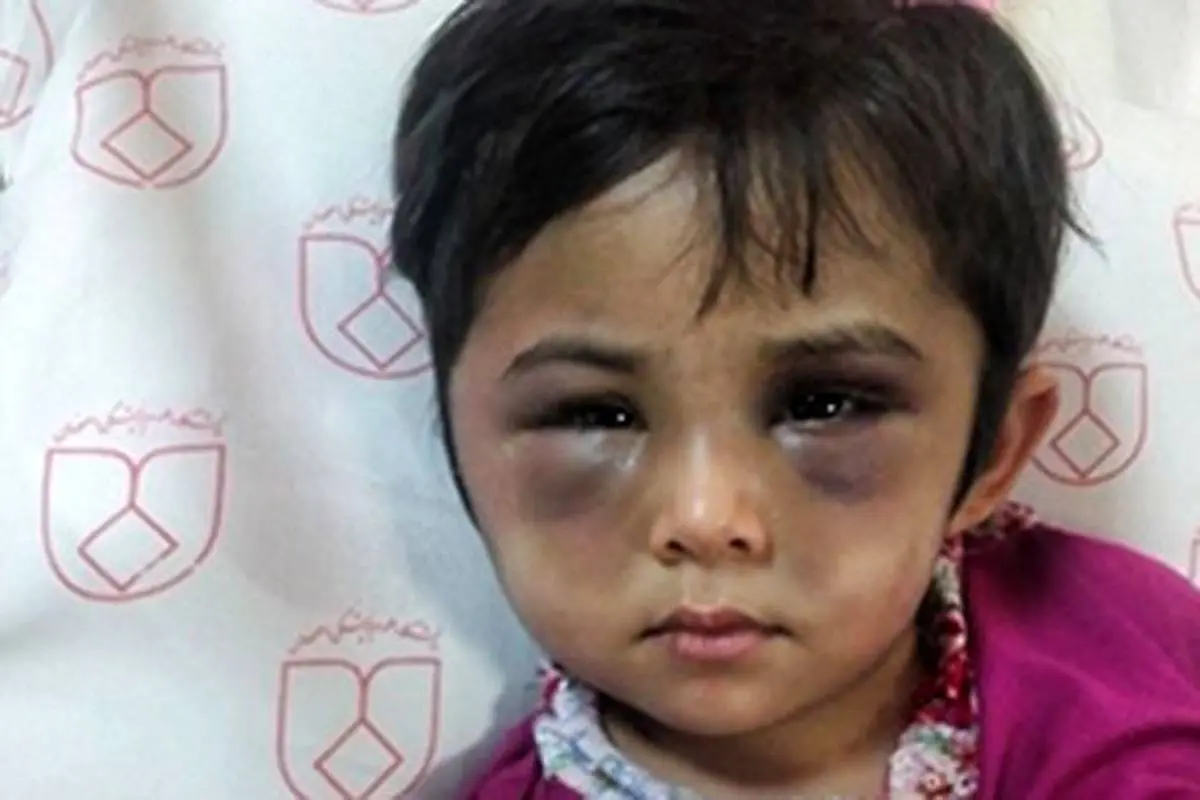 کودک آزار دیده با صورت کبود +عکس