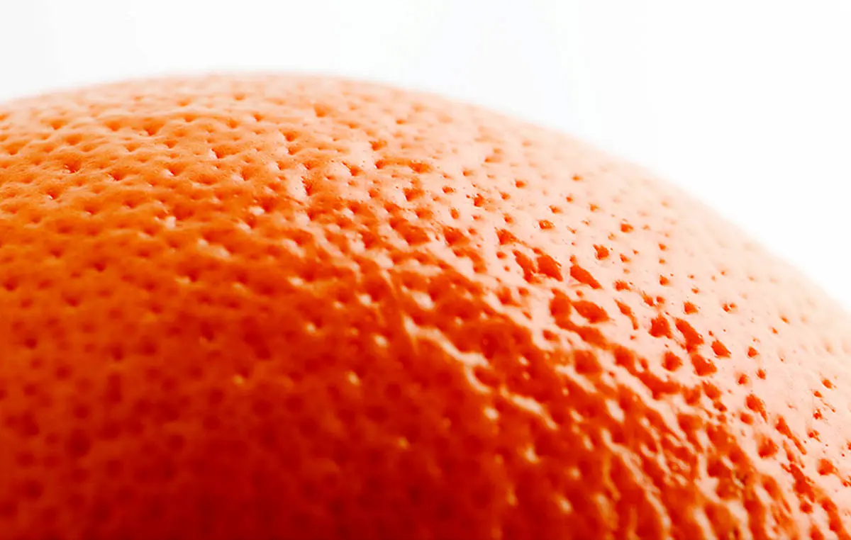 سلولیت؛ عارضه‌ای پوست پرتقالی که زنان را تهدید می‌کند
