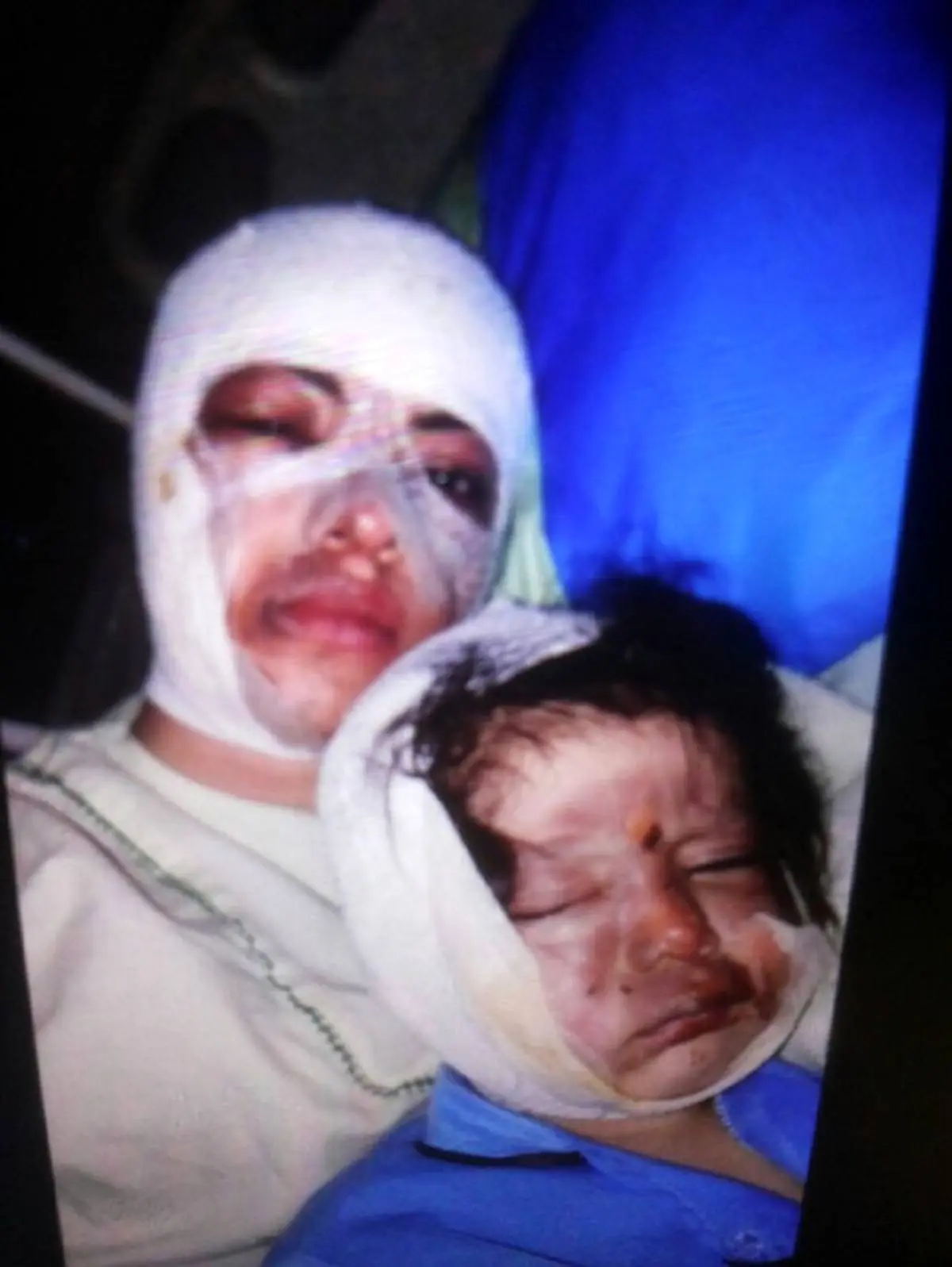 جزئیات اسیدپاشی روی صورت عمه و کودک ۲ ساله + عکس