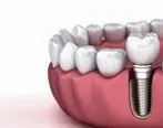 انواع ایمپلنت دندان ( هزینه و مزایا ) 