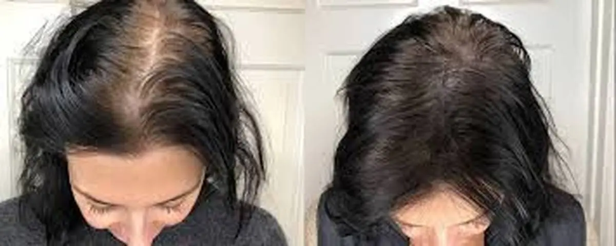 4 راهکار برای پرپشت شدن مو سر | موهای نازک خود را درمان کنید