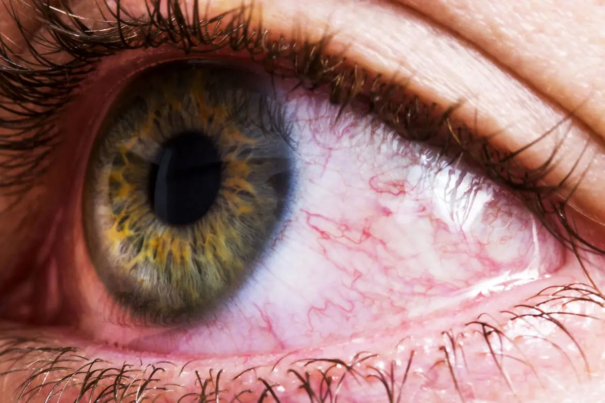 دلیل قرمزی چشم+درمان