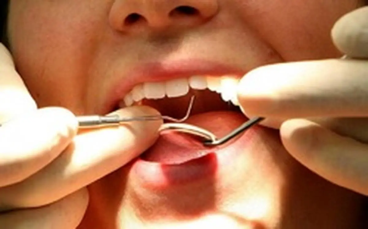 عوامل ایجاد جرم دندان
