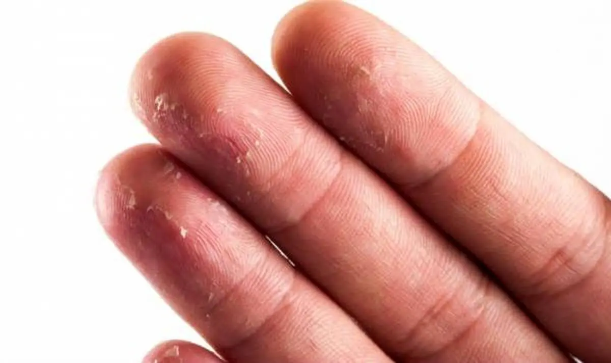چرا سر انگشتان پوسته می شوند؟ + راه های درمان