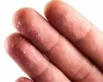 چرا سر انگشتان پوسته می شوند؟ + راه های درمان