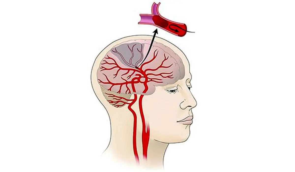 خطر سکته مغزدی در این افراد بالا است